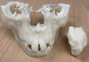 Sjúklingur líkan 3D prentuð á Form 2 Patient model 3D printed on Form 2